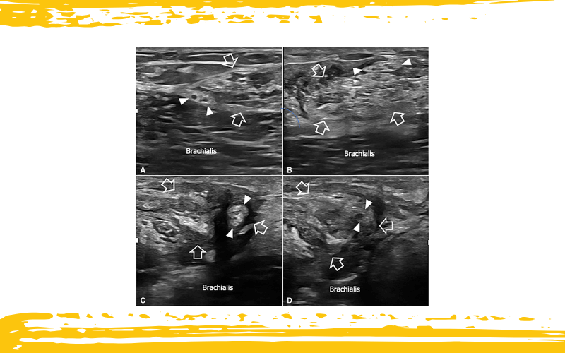 5. Nervio cutáneo lateral antebrazo.png